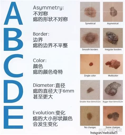 陰囊 黑痣|陰囊上的痣：是否需要切片檢查和去除？